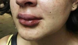 Mulher é agredida com soco na boca após se negar a dar dinheiro para ex-companheiro