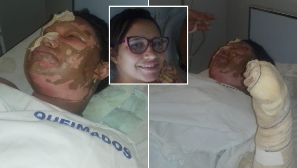 Paulo Afonso: Mulher queimada pelo companheiro é transferida para Juazeiro (Imagens fortes)