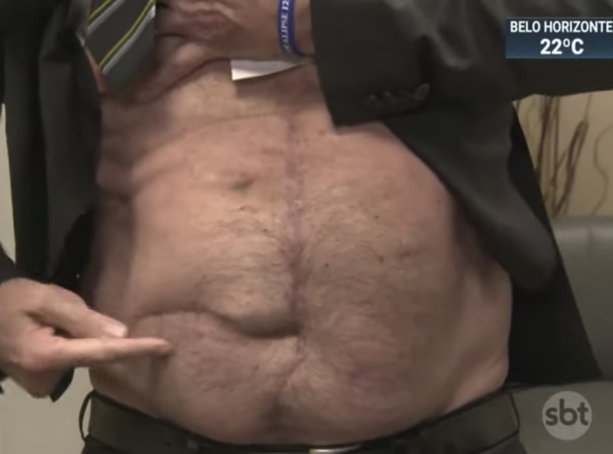 Bolsonaro mostra cicatriz para dizer que facada não foi fake