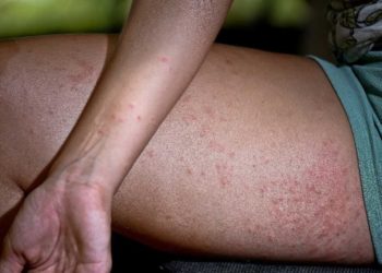 Coceira misteriosa: sobe para 18 número de cidades com registro de casos em Pernambuco