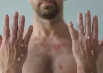 Bahia registra primeiro caso de varíola dos macacos; outros dois casos são suspeitos
