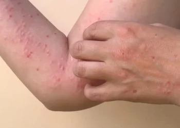 Bahia já soma 55 casos de Monkeypox