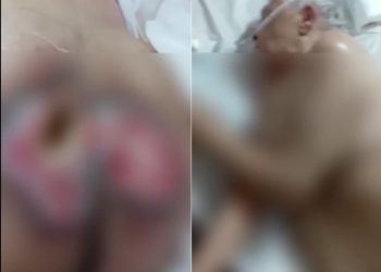 Paulo Afonso: idosa desenvolve lesões profundas provocadas por escaras e precisa de ajuda para tratamento