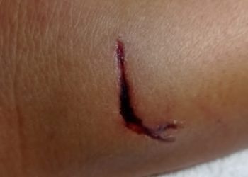 Mulher fica com buraco na perna após ser mordida por cães no centro de Paulo Afonso