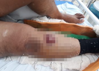 De novo – Cachorro solto na rua provoca mais um acidente em Paulo Afonso; vítima sofre fratura e precisa de transferência