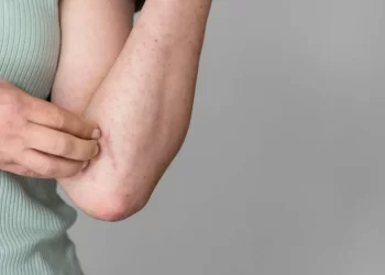 Febre Oropouche: sobe para 839 o número de casos na Bahia; saiba qual é a cidade com mais diagnósticos